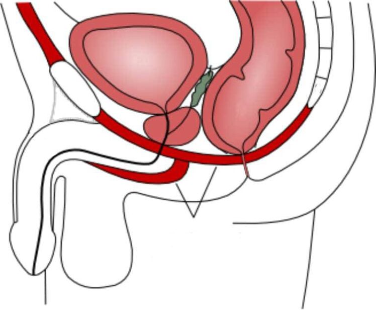 melatih otot lantai pelvis untuk meningkatkan potensi